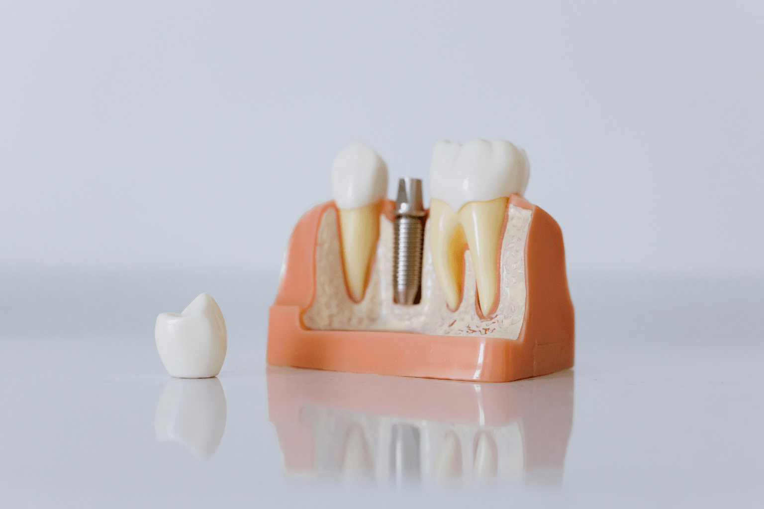протезированние зубов