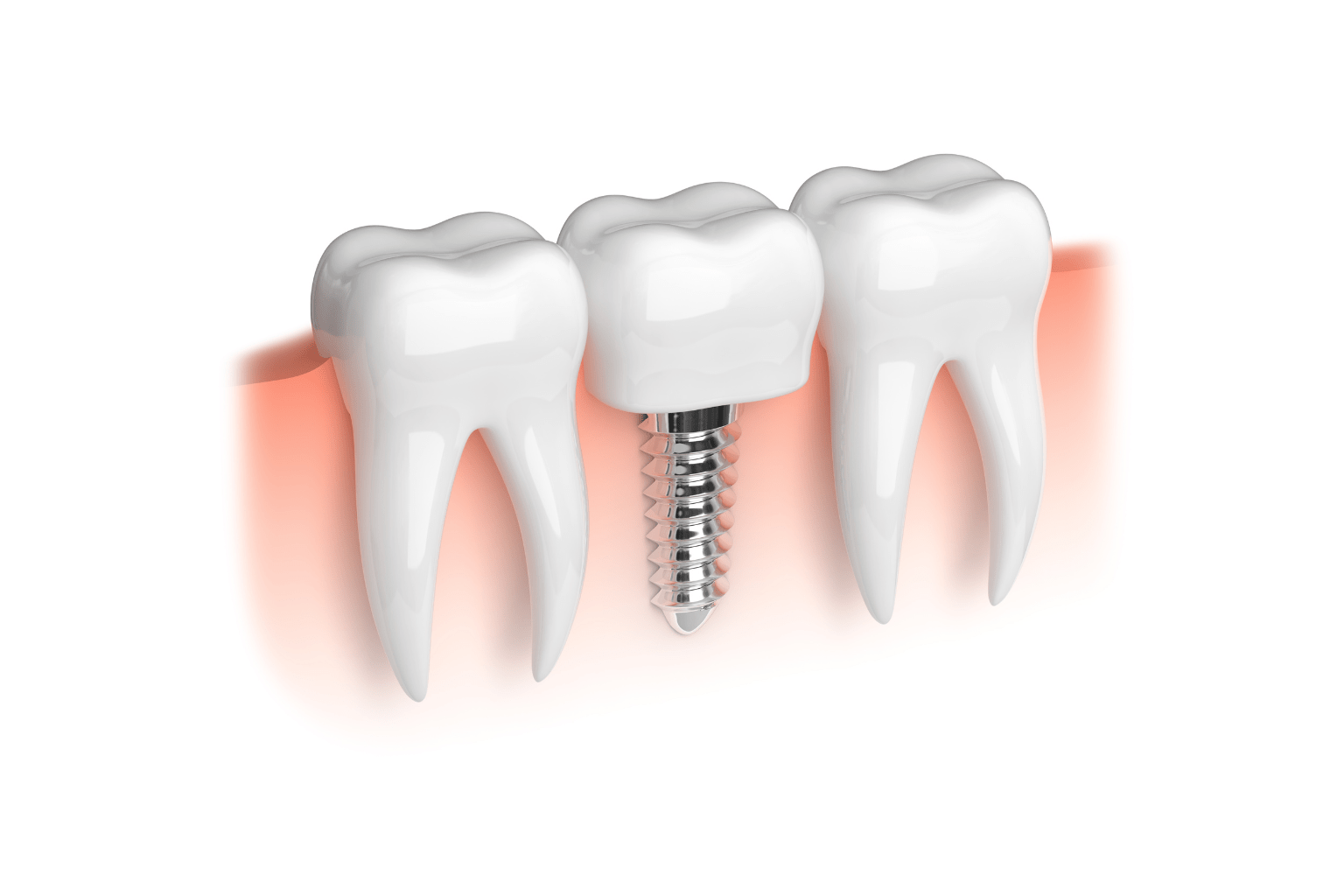 как проходит имплантация зубов