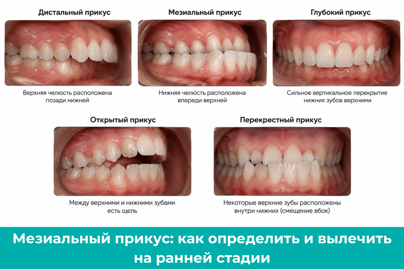 Мезиальный прикус: как определить и вылечить на ранней стадии