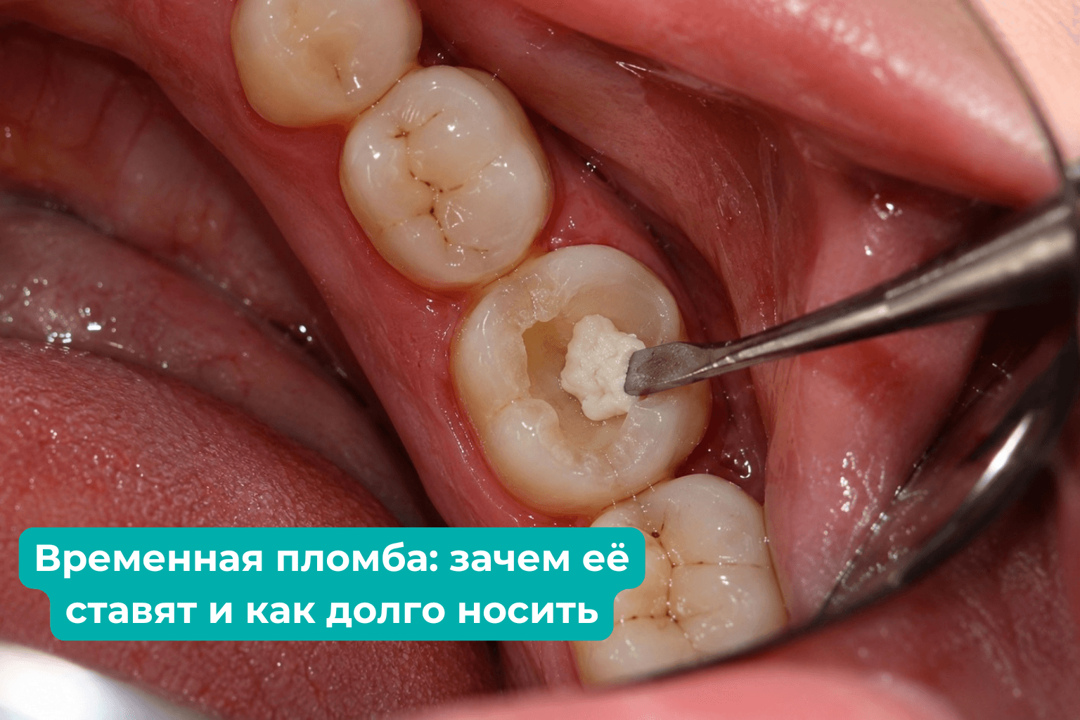 : зачем её ставят и как долго носить